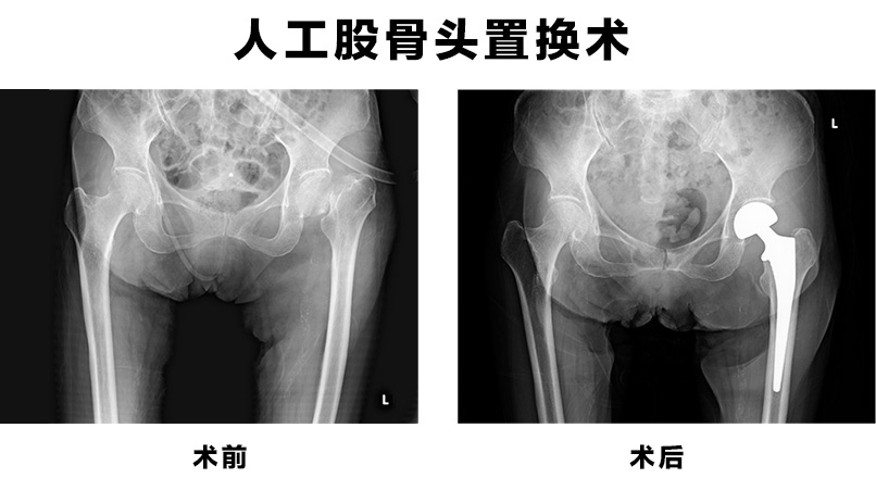 人工骨頭置換術