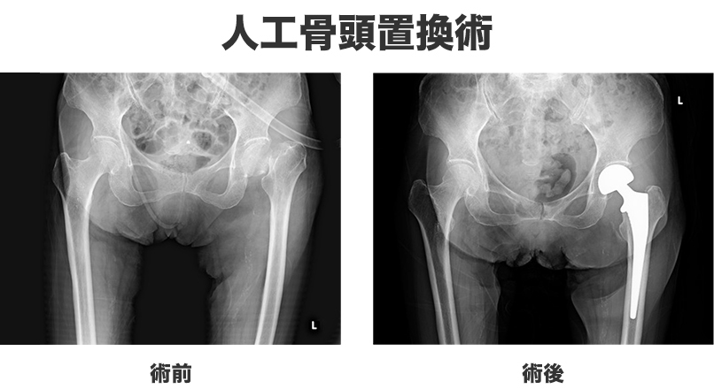 人工骨頭置換術